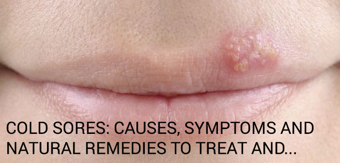 Cold Sores Causes Symptoms And Natural Remedies To Treat And Prevent It